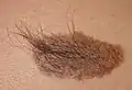 Becker's nevus