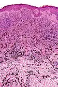 Micrograph of a blue nevus showing the characteristic pigmented melanocytes between bundles of collagen. H&E stain