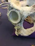 Skeleton of 92-year old woman 20 years after hip replacement