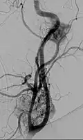 Digital subtraction arteriogram of carotid body tumor and jugular paraganglioma