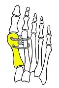 Cerclage bone sutures