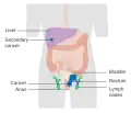 Stage 4 anal cancer