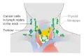 Stage N1b thyroid cancer
