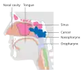 Stage T3 nasopharyngeal cancer
