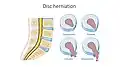 Illustration showing disc degeneration, prolapse, extrusion and sequestration