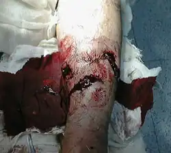 Gustilo type II open fracture