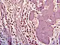 Histopathology of eosinophilic cholecystitis
