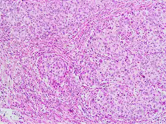 Invasive squamous cell carcinoma of the cervix is characterized by infiltration as irregular anastomosing nests or single cells.[75] This case is poorly differentiated. H&E stain.