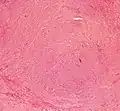 Histopathology of uterine fibroids typically show smooth muscle in a whorled (fascicular) pattern.[40]