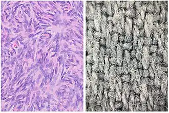 Woven or storiform: Elongated cells or nuclei wherein small bundles are aligned in an otherwise haphazard pattern.