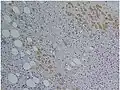 Immunohistochemical staining of trophozoites (brown) using specific anti–Entamoeba histolytica macrophage migration inhibitory factor antibodies in a patient with amoebic colitis.