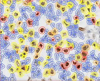 Ki67 stain calculation by QuPath in a pure seminoma, which gives a measure of the proliferation rate of the tumor. The colors represent the intensity of expression: blue-no expression, yellow-low, orange-moderate, and red-high expression.[16]