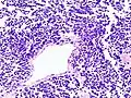 Histopathologic image of small-cell carcinoma of the lung. CT-guided core needle biopsy.