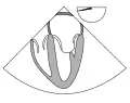 0° four chamber