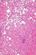 Micrograph showing a Mallory body. Original magnification 200X. H&E stain.
