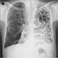 A severe case of bullous emphysema