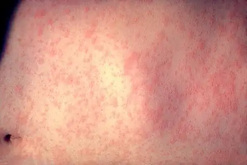 Abdominal maculopapular rash on day 3 of illness