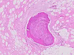 Fig. 1 Micrograph of bone formation in a liposarcoma tumor