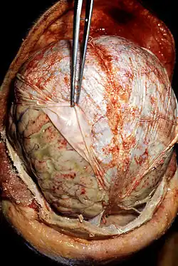 Acute infective meningitis