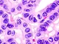 Micrograph (high power view) showing nuclear changes in papillary thyroid carcinoma (PTC), which include groove formation, optical clearing, eosinophilic inclusions and overlapping of nuclei. H&E stain.