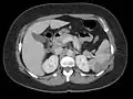 Thrombus of the left ventricle resulting in embolism of the spleen[9]
