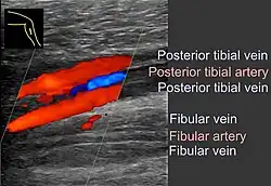 Coronal plane (seen from medial side of lower leg) ultrasonography of deep vein thrombosis of the fibular veins, seen as hyperechoic content and only marginal blood flow.